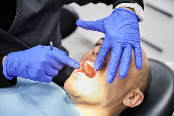 Best Emergency Wisdom Tooth Extraction in North Tustin, CA